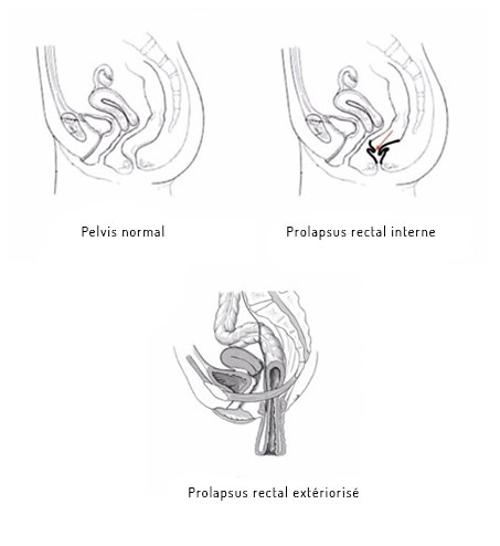 prolapsus rectum schema chirurgie lille louviere