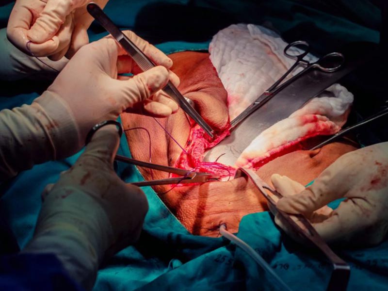 bloc laparotomie suture chirurgie lille louviere