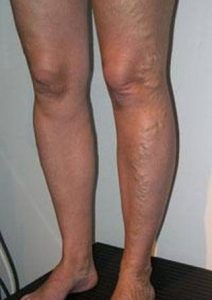varice jambe chirurgie lille louviere